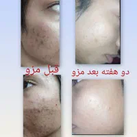 ،فشیال رفع کک ومک جوش و جوانسازی آقایون و بانوان