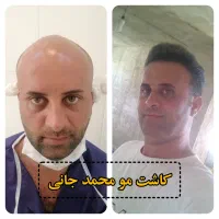 کاشت مو ،ابرو و ریش در شیراز|خدمات آرایشگری و زیبایی|کازرون, |دیوار