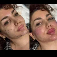 جشنواره ژل بوتاکس فیلر لیزرجوانسازمزو|خدمات آرایشگری و زیبایی|تبریز, |دیوار