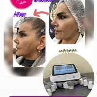 فرصت بسیارویژه لیزر ،هایفوتراپی ،ژل بوتاکس ،منظریه|خدمات آرایشگری و زیبایی|فردیس, منظریه|دیوار