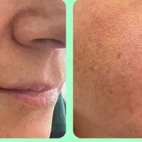 تزریق ژل بوتاکس فیلر چشم هایفو مزو جوانساز زاویه|خدمات آرایشگری و زیبایی|تهران, هفت حوض|دیوار