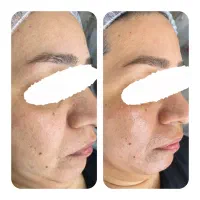 پاکسازی و فیشال پوست|خدمات آرایشگری و زیبایی|مشهد, امام رضا (ع)|دیوار