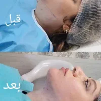 لیپوساکشن|خدمات آرایشگری و زیبایی|بروجرد, |دیوار