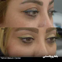 عمل بینی/ کاشت ابرو و مو / بلفارو /تزریق چربی|خدمات آرایشگری و زیبایی|قم, نوبهار|دیوار