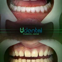 کامپوزیت، لمینت، ایمپلنت اقساط ویژه|خدمات آرایشگری و زیبایی|ری, شهرری|دیوار