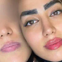 تزریق ژل لب روسی بوتاکس لیزر بیکینی زاویه(پزشک)