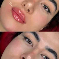 فیلرلب /طبیعی /روسی/تزریق فقط توسط دکتر