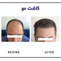 کاشت مو و ابرو نقد و اقساط