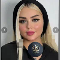 ژل و بوتاکس لیفت نخ زاویه سازی«فقط خانم ها