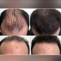 واسه پرپشت شدنش اقدام کن