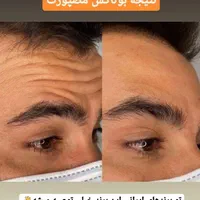 بوتاکس ژل آنزیم نخ لاغری بوتاکس 650 ژل اودری 450