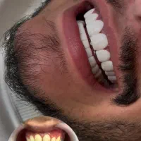 کامپوزیت دندان