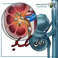 درمان طبیعی سنگ کلیه فوری