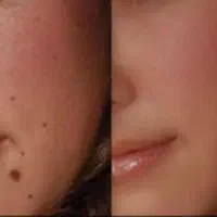 حذف کک و مک ،خال ،منگوله گوشتی بدون برگشت گیاهی|آرایشی، بهداشتی، درمانی|زنجان, |دیوار