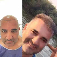 جشنواره کاشت مو ریش و ابرو|خدمات آرایشگری و زیبایی|اردبیل, |دیوار