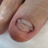 درمان ناخن های فرو رفته در گوشت