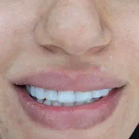 تخفیف ویژه کامپوزیت و عصب کشی  بمدت دوهفته