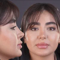 کامپوزیت لمینت ایمپلنت جراحی بینی بلفارو ساکشن