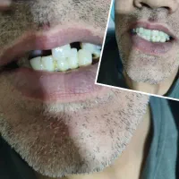 دندان مصنوعی اقساطی|خدمات آرایشگری و زیبایی|اصفهان, عطار نیشابوری|دیوار