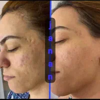 فیشیال vip ،درمان  مشکلات پوست،برداشتن خال ،زیگیل