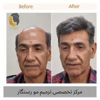 ترمیم مو /پروتز مو  / جایگزین کاشت مو و کلاهگیس|خدمات آرایشگری و زیبایی|اصفهان, آبشار|دیوار