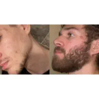 بالاخره کم پشتی ریش حل شد