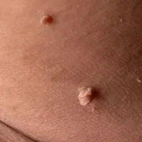 زائده روی پوستتو ریشه کن کن