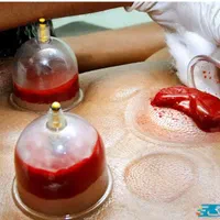 حجامت وفصد خون درمنزل در قرچک   پذیرفته میشود