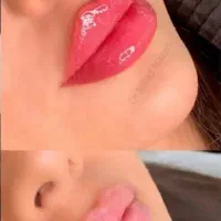 ژل/فیلر/بوتاکس/پی آرپی/بایو فیلر و چربی|خدمات آرایشگری و زیبایی|کرج, گوهردشت|دیوار
