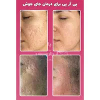 جشنواره پی آر پی prp در مطب پزشک|خدمات آرایشگری و زیبایی|اصفهان, برازنده|دیوار