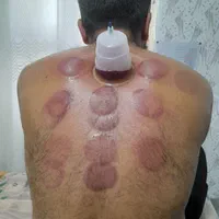 حجامت کاملا اصولی توسط شخص طبیب اسلامی و سنتی