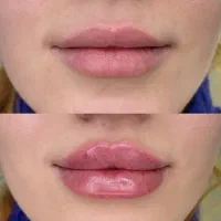 تزریق فیلر صورت