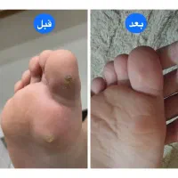 بهبودی زگیل تناسلی بدونه نیاز به فریز