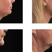 بوتاکس لیبل دار واحدی ۲۰۰ ژل اورجینال توسط پزشک|خدمات آرایشگری و زیبایی|اصفهان, احمدآباد|دیوار