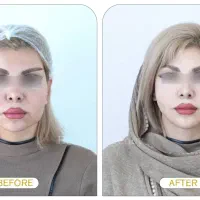 جوانسازی صورت/MACS LIFT/رینوپلاستی/لیفت صورت