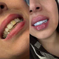 جشنواره کامپوزیت دندان/روکش/لمینت/بلیچینگ/عصب کشی