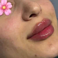 تزریق ژل و بوتاکس لیفت با نخ