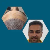 کاشت مو یا معجزه.محیط VIP،تیم شیراز در یزد(تضمینی)|خدمات آرایشگری و زیبایی|یزد, |دیوار