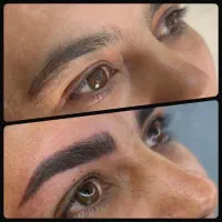 میکروبلیدینگ  فیبروز بن مژه