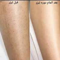 پوستی ابریشمی با لیزر کندلا،۵۰۰.۰۰۰ت اعتبار باشگاه