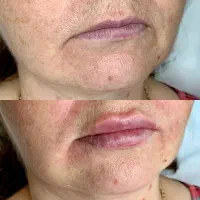 جشنواره آموزشی فیلر نخ بوتاکس زیر نظر دکتر...|خدمات آموزشی|تهران, قلهک|دیوار