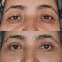 بلفاروپلاستی فقط با ۹ میلیون تومان در تهران|خدمات آرایشگری و زیبایی|باقرشهر, |دیوار