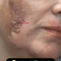 حذف لک و کک ومک وپینه پا بانوان و اقایان