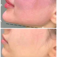 فیلر بوتاکس