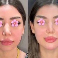 ژل و بوتاکس صورت در مطب (فقط هزینه مواد )