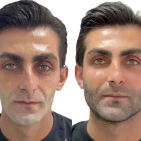 آف فیلر بوتاکس و prpو فیلربادی وچالگونه مطب