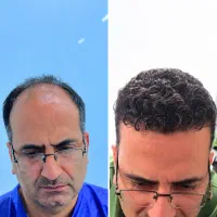 کاشت مو فول تراکم و ابرو