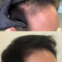 میکرواسکالپ تخصصی با جدیدترین متدvip|خدمات آرایشگری و زیبایی|مشهد, گوهرشاد|دیوار