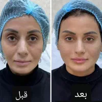 فیلرلب خط خنده فول فیس مزو نیدیلینگprp لیزرموزائد