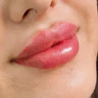 ژل لب کانتورصورت بوتاکس مزوژل جوانسازی آنزیم بینی